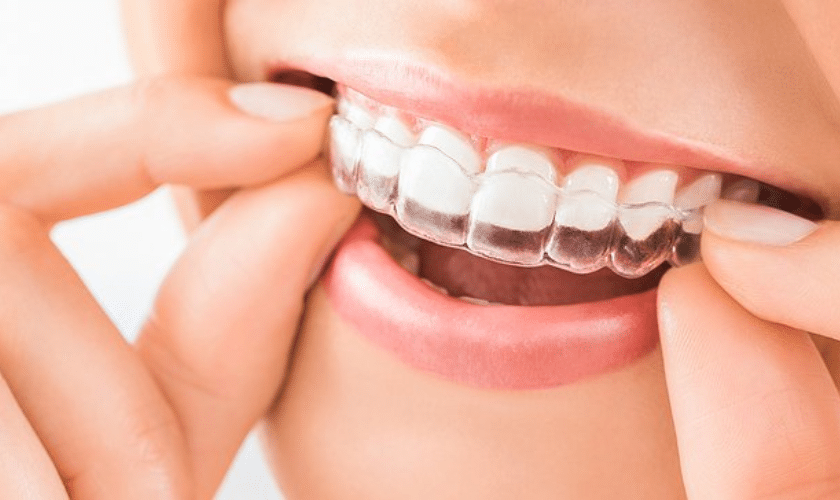 Dental Invisalign