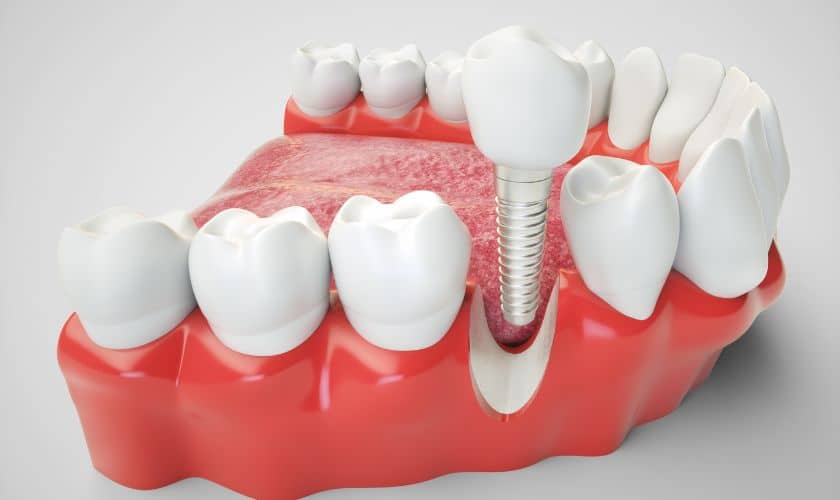 Dental Implants in Rio Rancho, NM - Rio Rancho Dental Associates