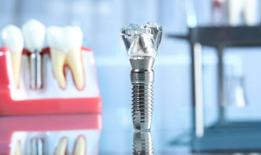 Dental Implants in Rio Rancho - Rio Rancho Dental Associates