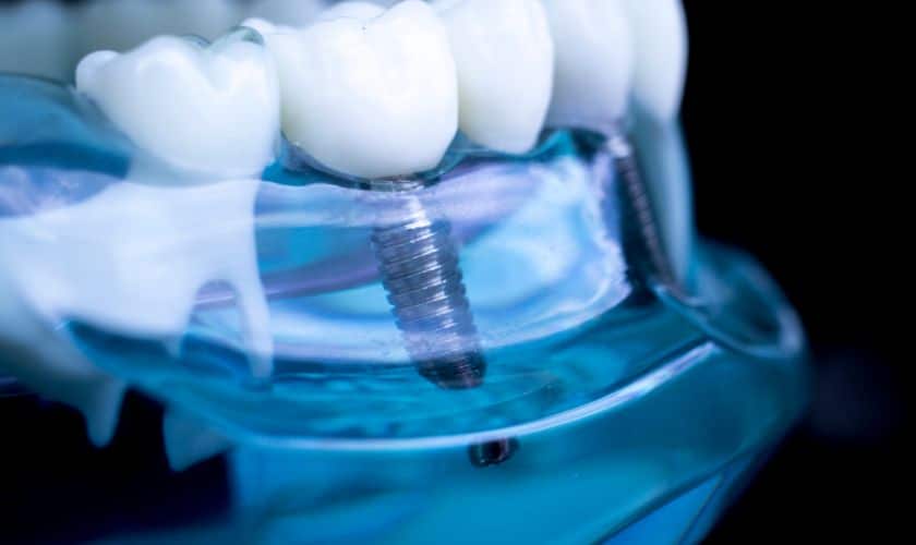 Dental Implants in Rio Rancho - Rio rancho Dental Association