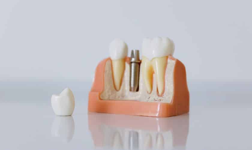 Dental Implants vs. Traditional Dentures: Making the Right Choice for You