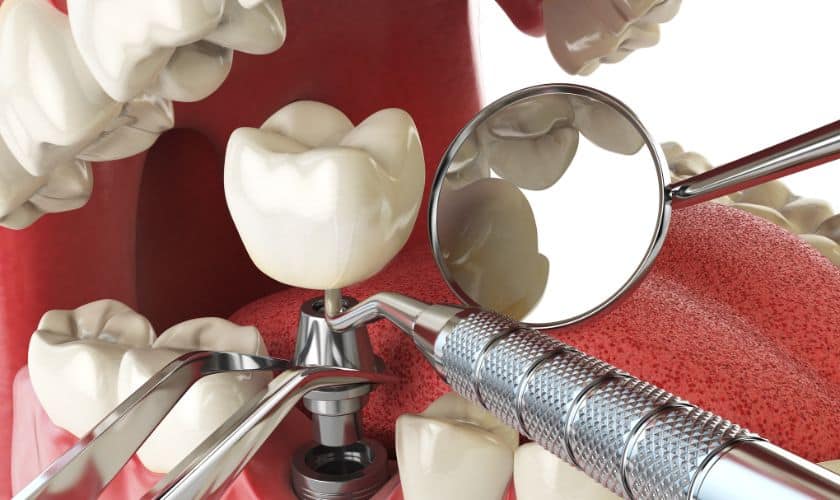 Dental Implant Aftercare: A Guide To Ensuring Long-Lasting Success In Rio Rancho