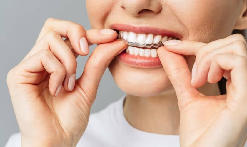 Exploring the Benefits of Invisalign for Orthodontic Treatment