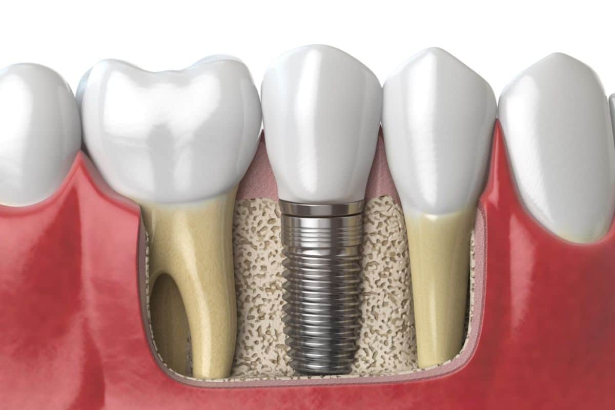 Dental implants in Rio Rancho Dental implants in Rio Rancho for missing teeth restoration