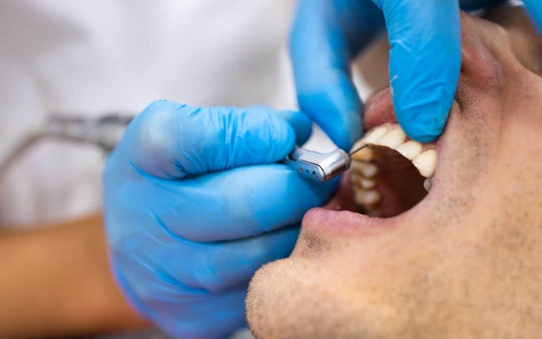 A Step-by-Step Guide to the Bone Grafting Procedure