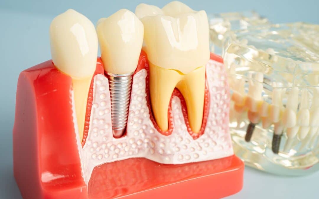 Are Dental Implants Permanent? Myths and Facts You Should Know
