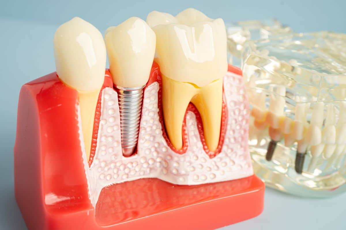 Dental Imaplants Dental implant model showing artificial tooth, implant screw, and gum structure.