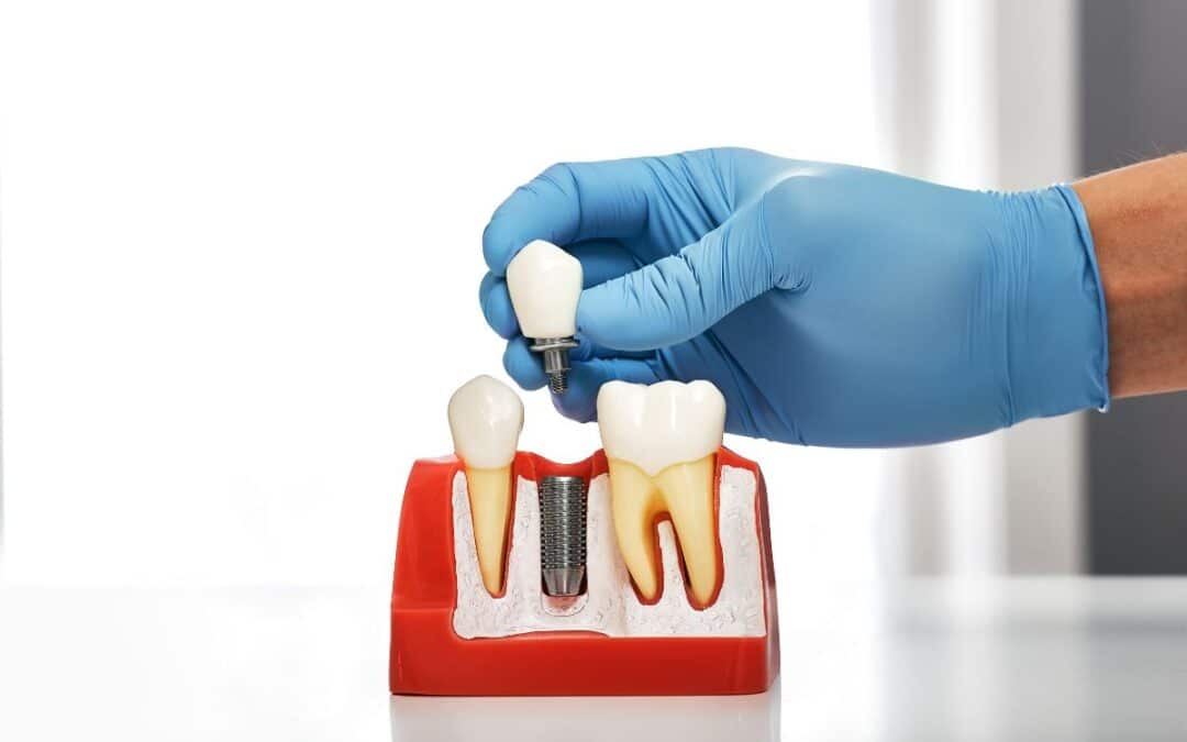 Dental Implant Healing: A Day-by-Day Guide to a Smooth Recovery