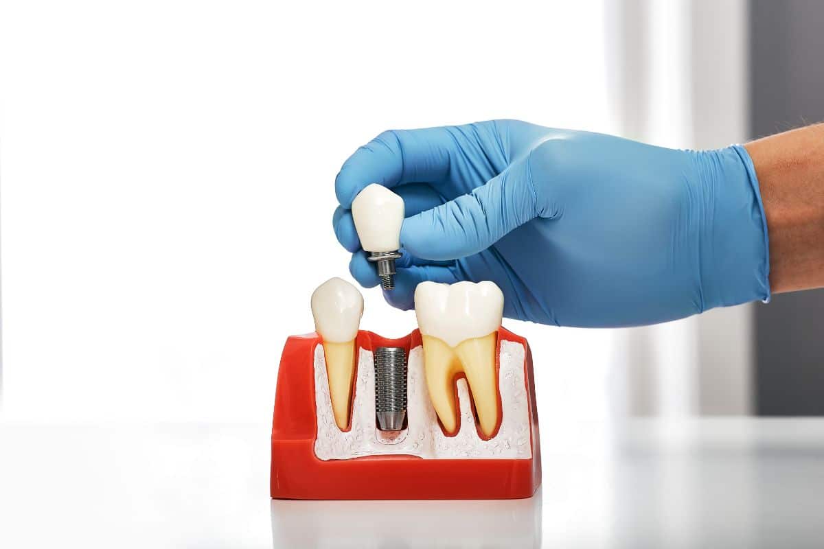 Close-up of dental implant and crown placement demonstration.